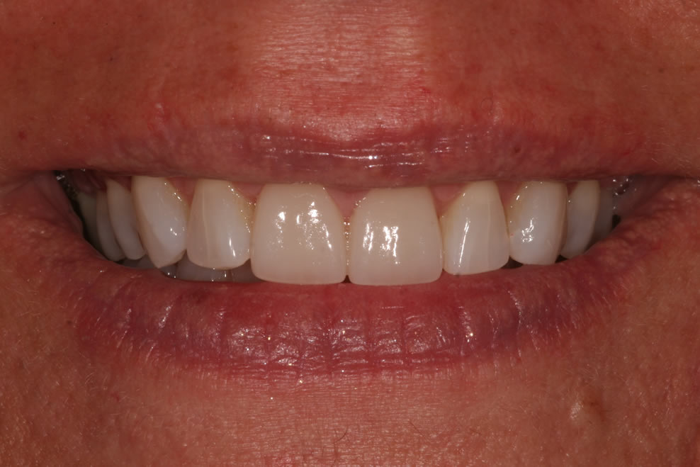 gums too visible?